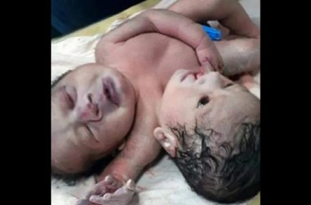 Inde: une femme donne naissance à des «jumeaux siamois rares»