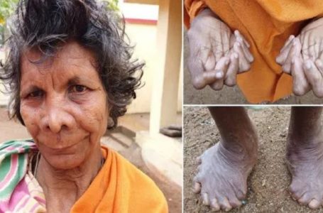 Inde: découverte d’une femme avec 31 doigts et orteils-PHOTOS