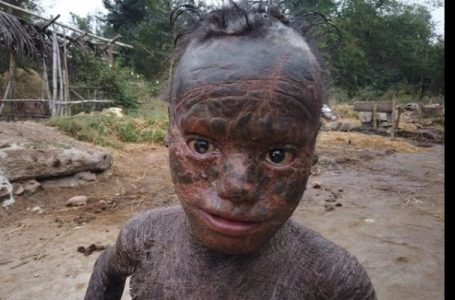 Inde : âgé de 10 ans, il souffre d’une maladie qui lui fait perdre la peau comme un reptile (photos)